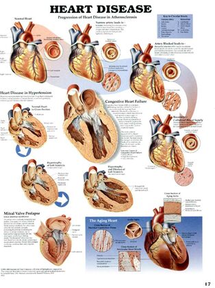 Plansze Anatomiczne - Plansze anatomiczne choroby-serca.jpg